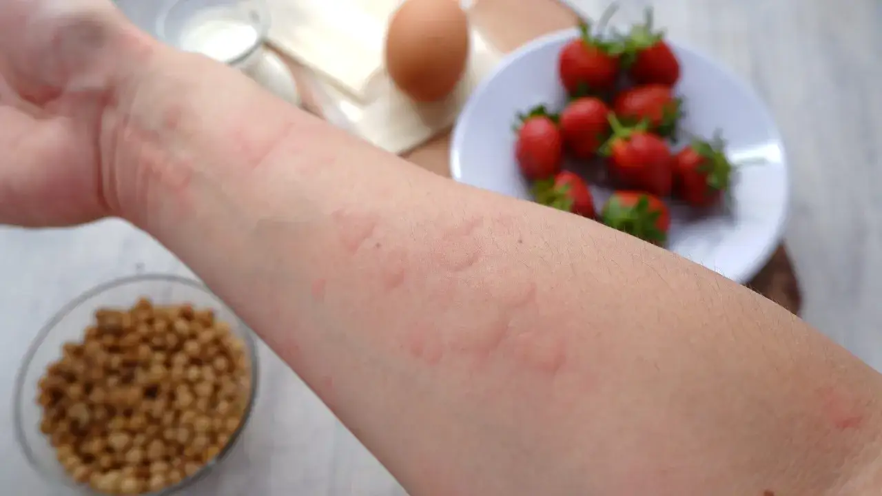 dziecko alergia na jajka ciasto